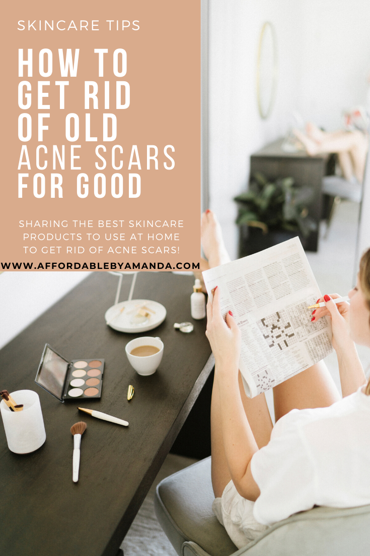 How to Get Rid of Acne Scars For Good. Affordable by Amanda, Style and Beauty Blogger in Tampa, Florida. The Best Products To Use For Acne Marks and Acne Scars. Start treating your acne scars today.