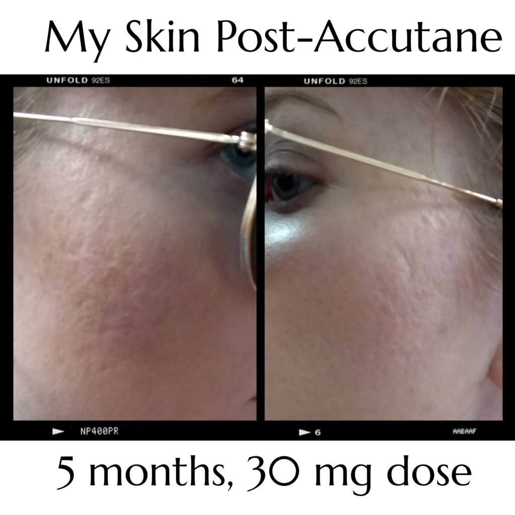 Skin After Accutane - Affordable by Amanda
