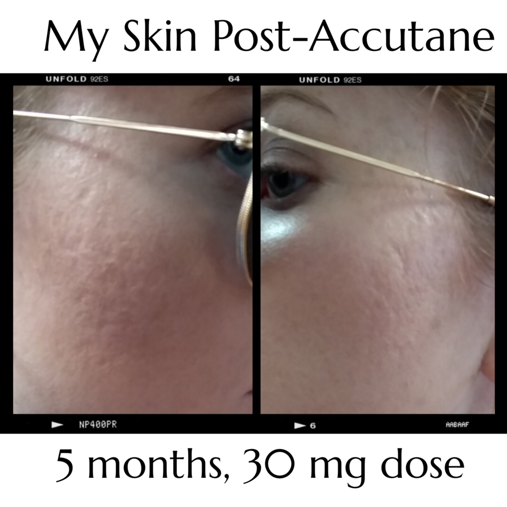 The day before I started Isotretinoin vs. 5 months in. Truly magic. (20mg/ day, 50 kg, Sotret) : r/Accutane