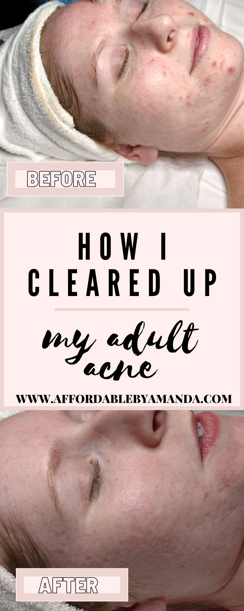 How I Cleared My Adult Acne.The Best Adult Acne Treatments 2020. How to Fight Adult Acne. The Best Adult Acne Remedies. Adult Acne Products. Adult Acne Skin Care Tips.